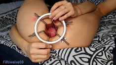 Thumbnail of Anal Dilator In Action