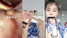 Thumbnail of 拍摄喉咙特写的新方法探索